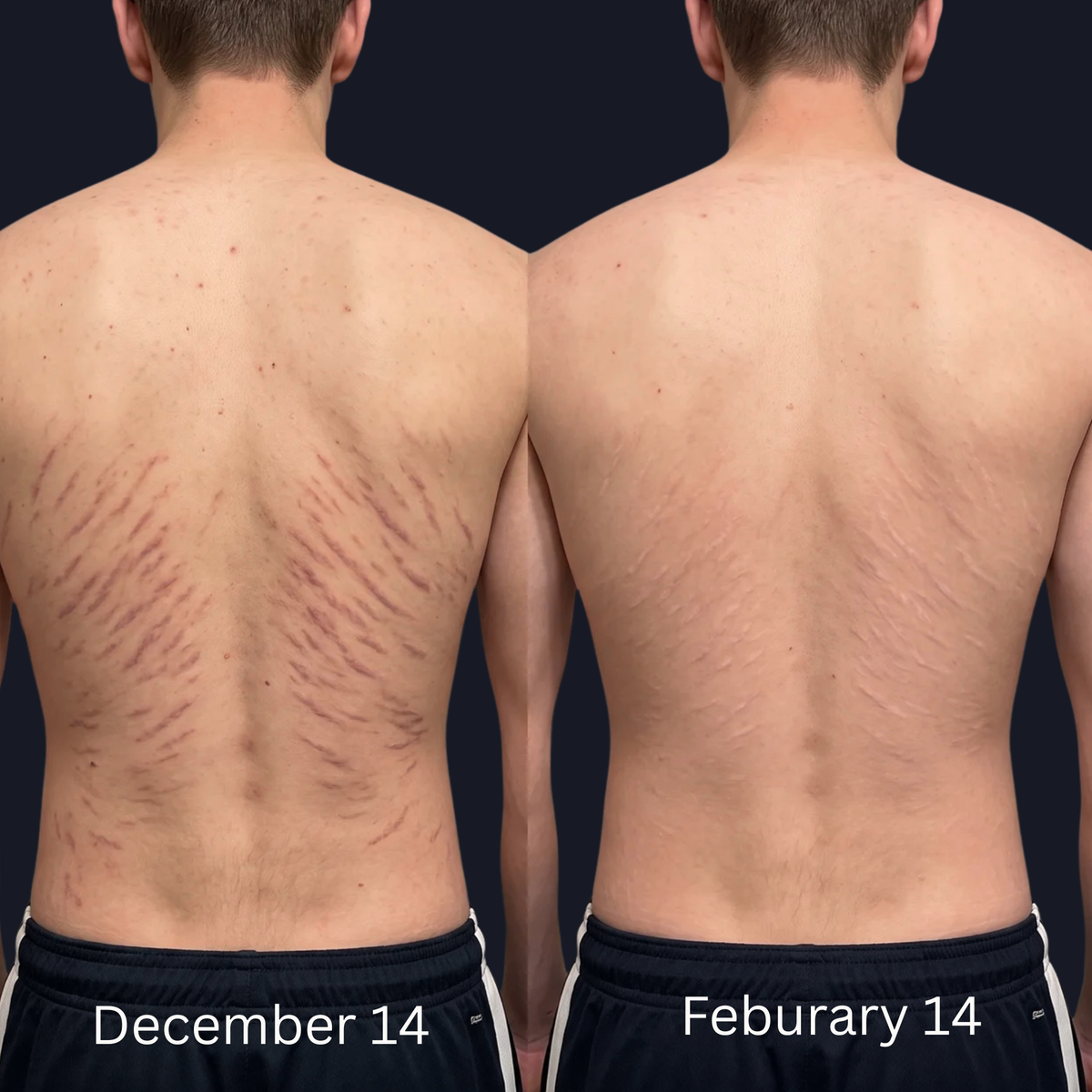 AERIKA™ Revitalizing Stretch Mark Serum