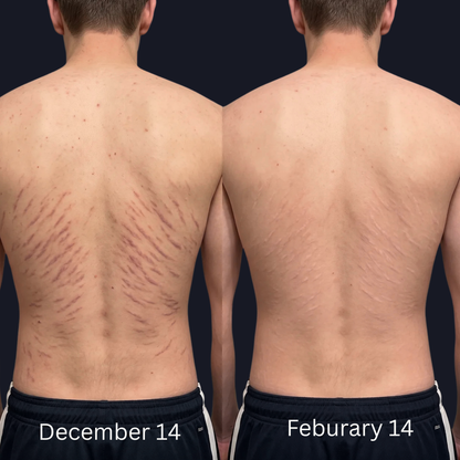 AERIKA™ Revitalizing Stretch Mark Serum