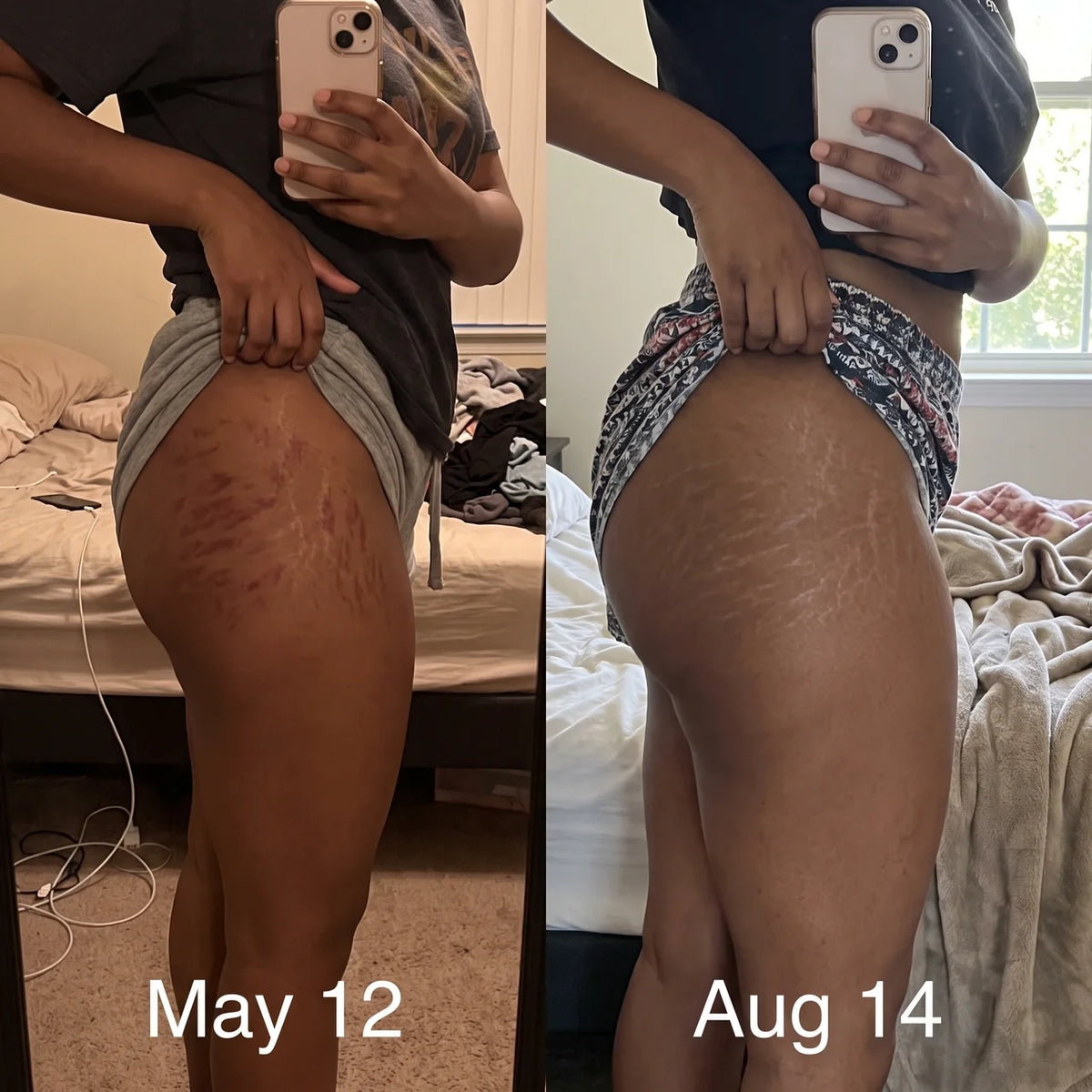 AERIKA™ Revitalizing Stretch Mark Serum